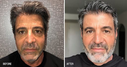 Patient before and after Farmington Renuva treatment.