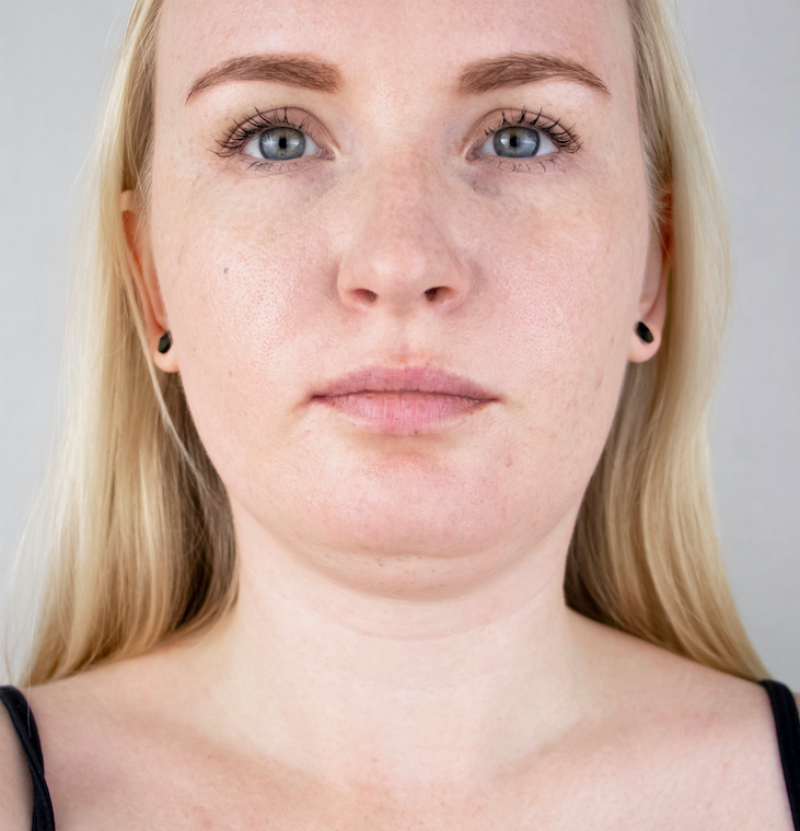 Close-up portrait of before Farmington Med Spa treatment.